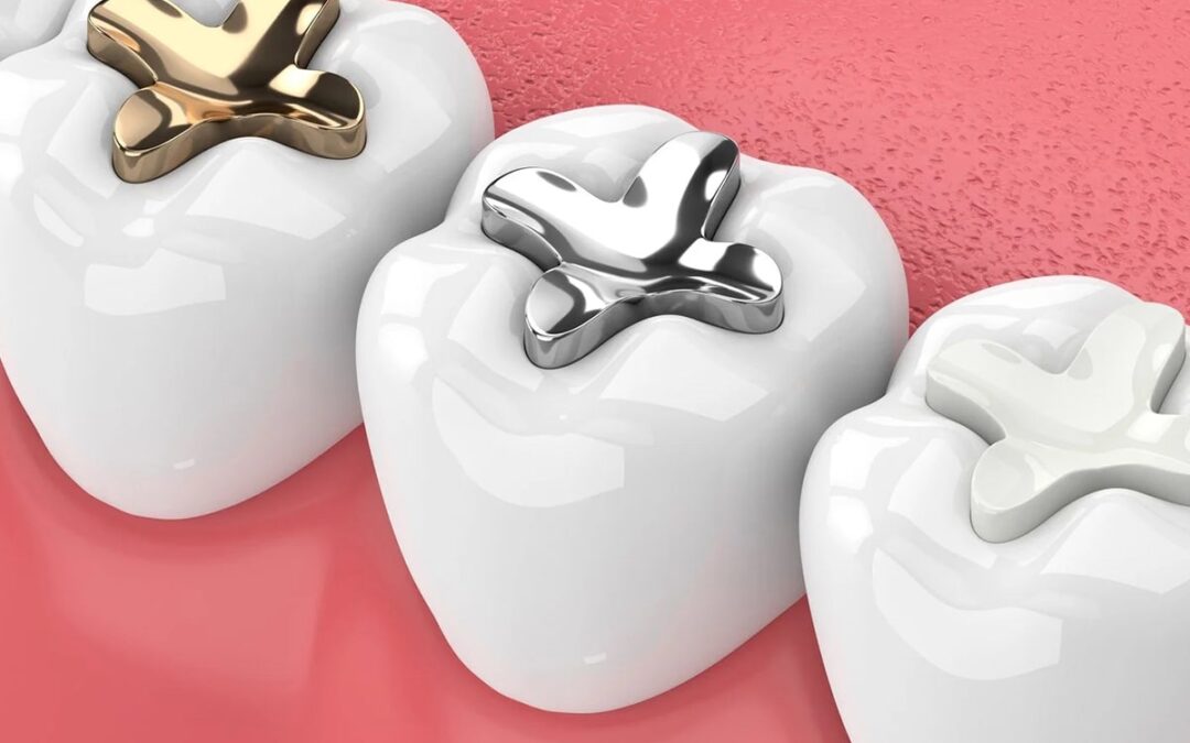 Amalgam Fillings