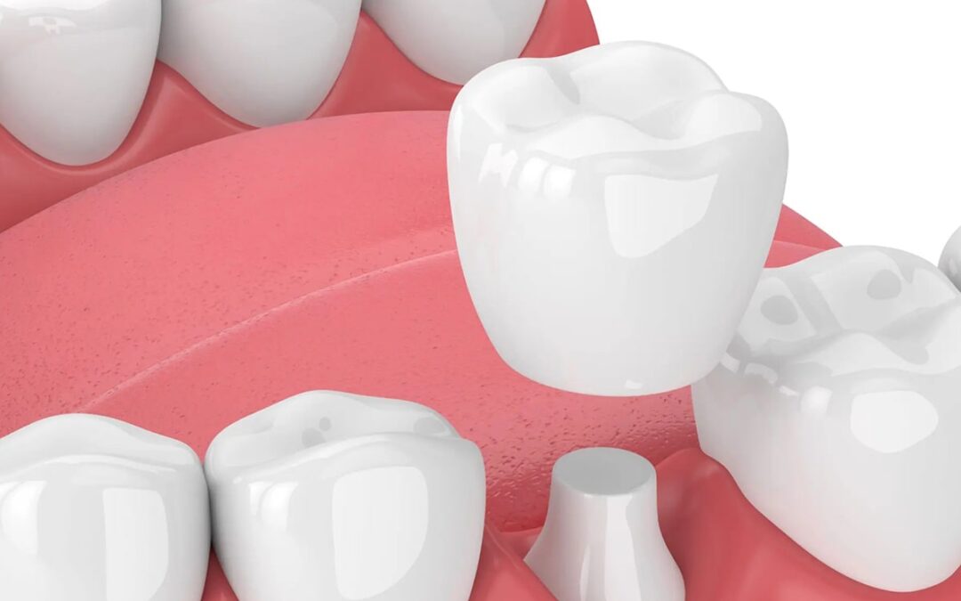 Ceramic Crowns