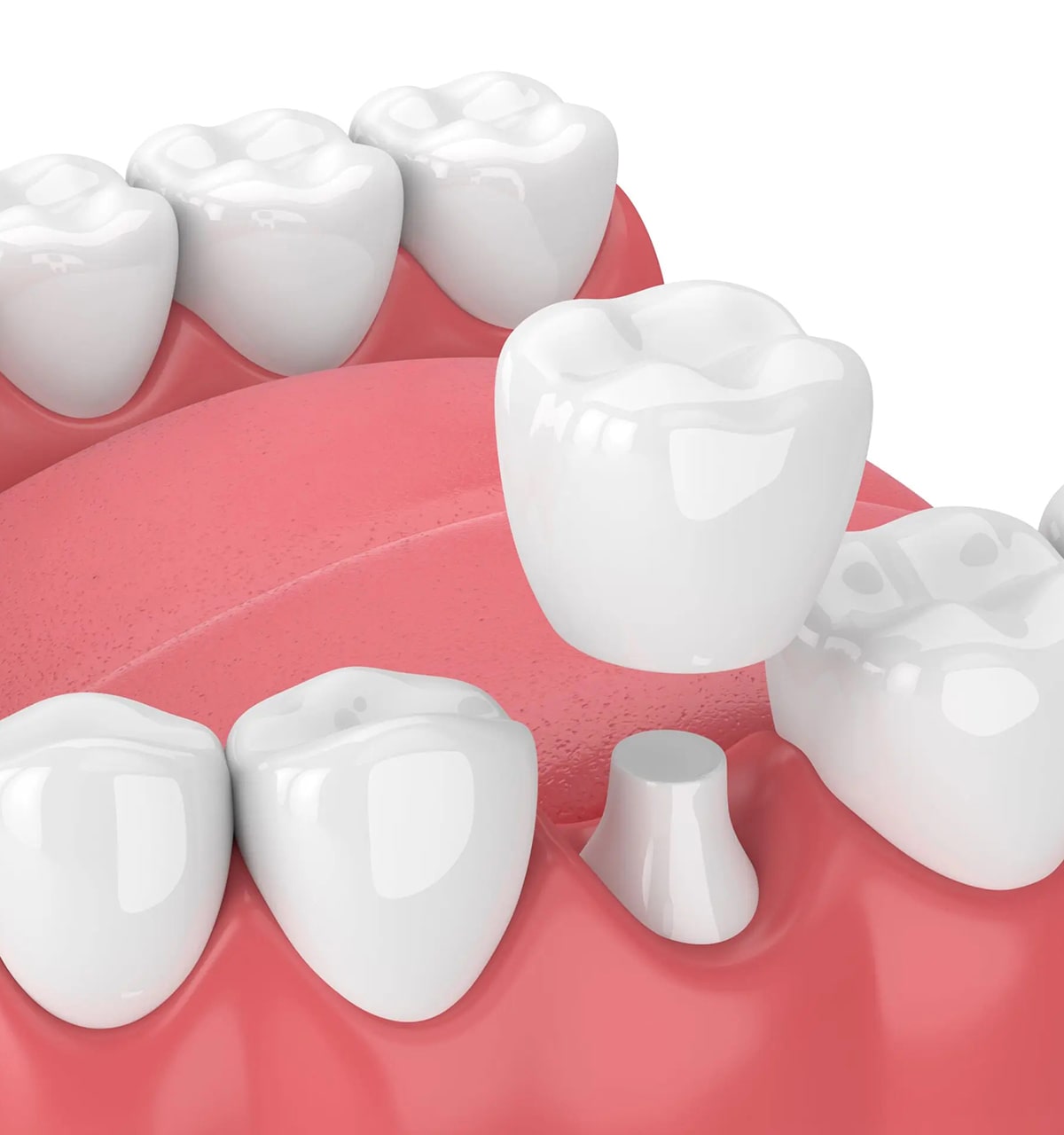 Ceramic Crowns Family Dental and Advanced Implant Center