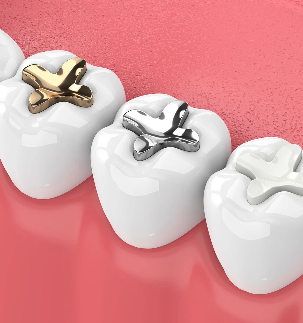 Inlays and Onlays Family Dental and Advanced Implant Center